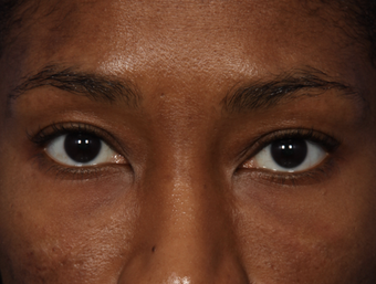 Restylane after 302213