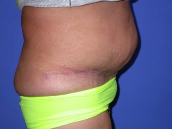 panniculectomy 1034648