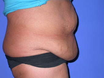 panniculectomy 1034648