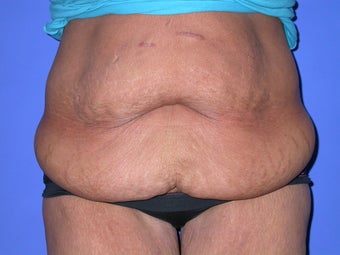panniculectomy before 1034648