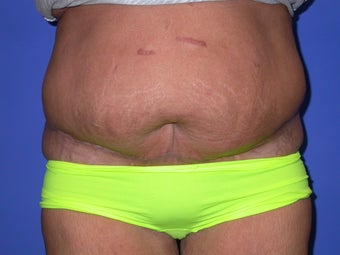 panniculectomy after 1034648