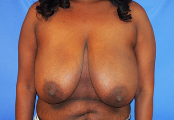 35-year-old woman treated with Breast Lift before 3326239