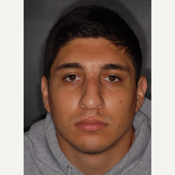 25-34 year old man treated with Nose Surgery 3 years post-op before 3814073
