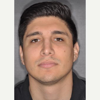 25-34 year old man treated with Nose Surgery 3 years post-op after 3814073
