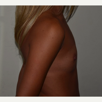 325cc Moderate Plus Profile Silicone Cohesive Gel Implants before 3840019