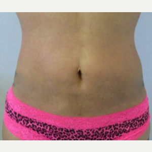 Liposuction after 3094146