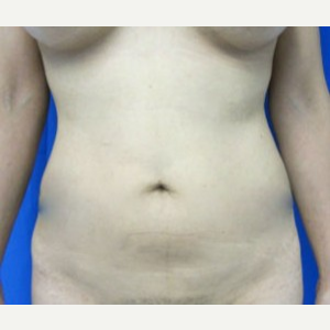 Liposuction before 3094146