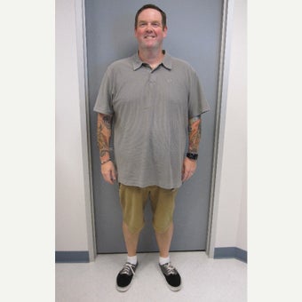 35-44 year old man treated with Sleeve Gastrectomy after 1922391