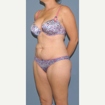 45-54 year old woman treated with Tummy Tuck before 3563655