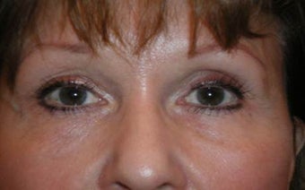 Restylane after 977802