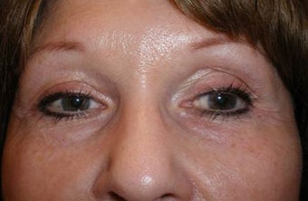 Restylane before 977802