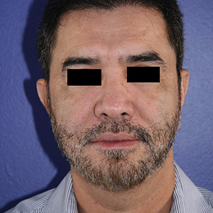 46 year old man treated with Chin Implant after 3710604