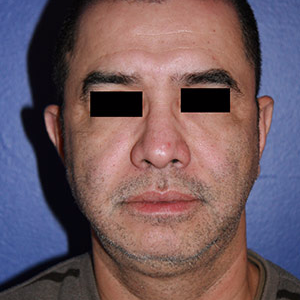46 year old man treated with Chin Implant before 3710604