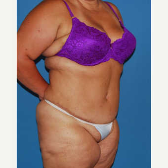 35-44 year old woman treated with Panniculectomy after 3542944
