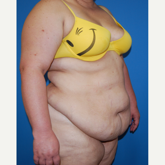 35-44 year old woman treated with Panniculectomy before 3542944