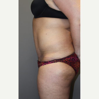 35-44 year old woman treated with Tummy Tuck after 3140828