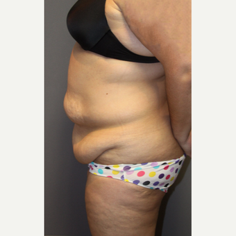 35-44 year old woman treated with Tummy Tuck before 3140828