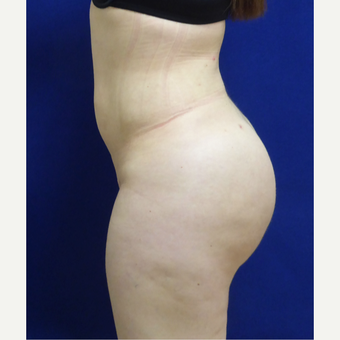 27 y/o female - 1500cc per side Lipo abdomen, flanks, back with fat transfer to the buttocks after 3433774