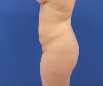 27 y/o female - 1500cc per side Lipo abdomen, flanks, back with fat transfer to the buttocks before 3433774