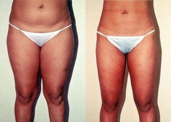 26-year-old woman treated with Liposuction. before 3287390