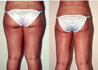 26-year-old woman treated with Liposuction. after 3287390