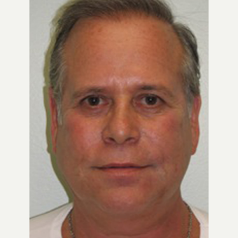 55-64 year old man treated with Non Surgical Face Lift after 3137538