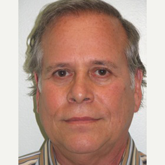 55-64 year old man treated with Non Surgical Face Lift before 3137538