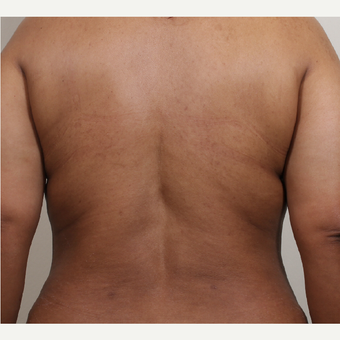35-44 year old woman treated with Liposuction of the bra rolls and waist after 3404726