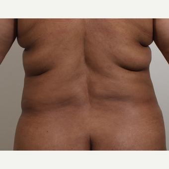 35-44 year old woman treated with Liposuction of the bra rolls and waist before 3404726