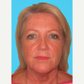 Facelift before 3824923
