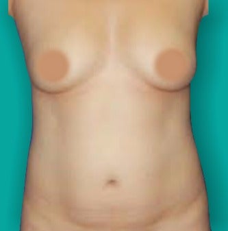 25-34 year old woman treated with Mommy Makeover before 3242144