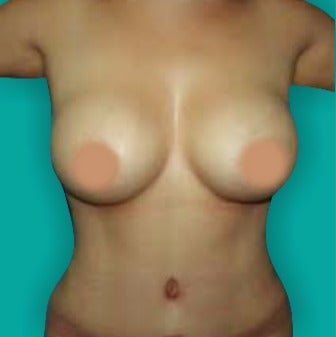 25-34 year old woman treated with Mommy Makeover after 3242144