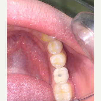 Single Molar Tooth Dental Implant after 3146144