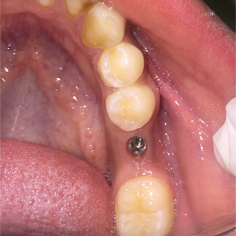 Single Molar Tooth Dental Implant before 3146144