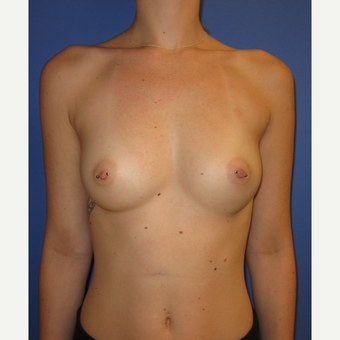 18-24 year old woman treated with Inspira Breast Implants (375cc) before 3374569