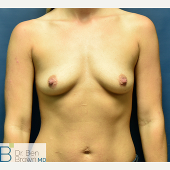 25-34 year old woman treated with Breast Augmentation before 3486942