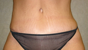 C.L.A.S.S ® Tummy Tuck after 926879