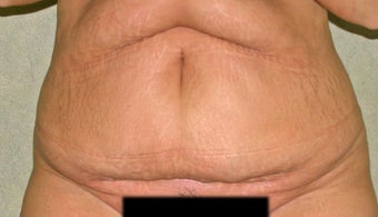 C.L.A.S.S ® Tummy Tuck before 926879