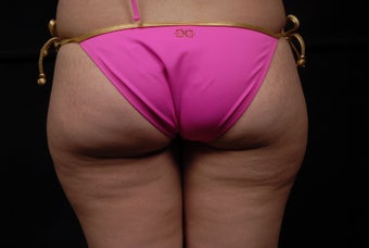 Liposuction with Body Jet before 403352