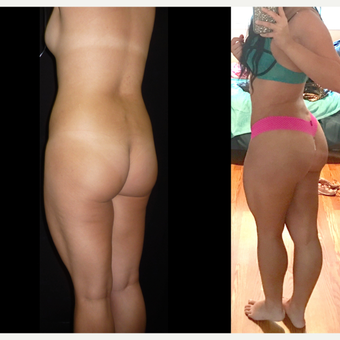 18-24 year old woman treated with Brazilian Butt Lift before 3680311