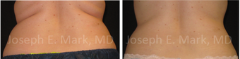 25-34 year old woman treated with CoolSculpting before 3660591