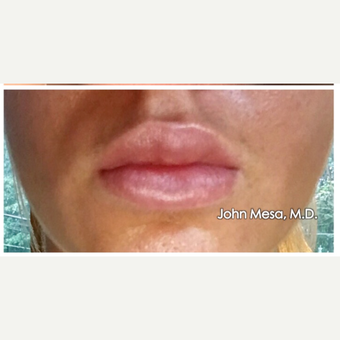 25-34 year old woman treated with Lip Augmentation after 3058429
