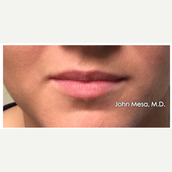 25-34 year old woman treated with Lip Augmentation before 3058429