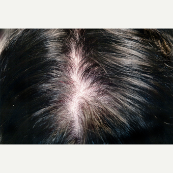 25-34 year old man treated with PRP for Hair Loss before 3803909