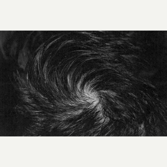 25-34 year old man treated with PRP for Hair Loss after 3803909