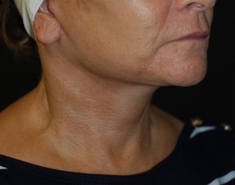 Necklift with facelift 1041674