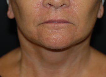 Necklift with facelift after 1041674