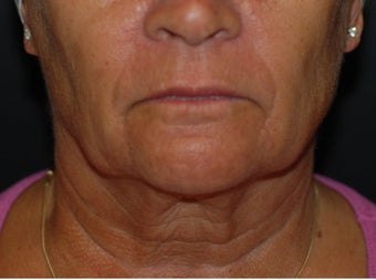Necklift with facelift before 1041674