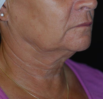Necklift with facelift 1041674