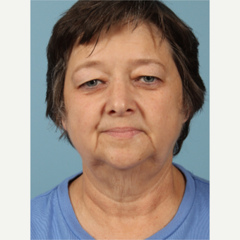 55-64 year old woman treated with Facelift before 3617660